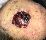 Niezgoda-Head Radiated Site-Failed Skin Graft